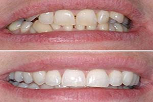 Six Month Smiles