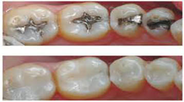 White Fillings