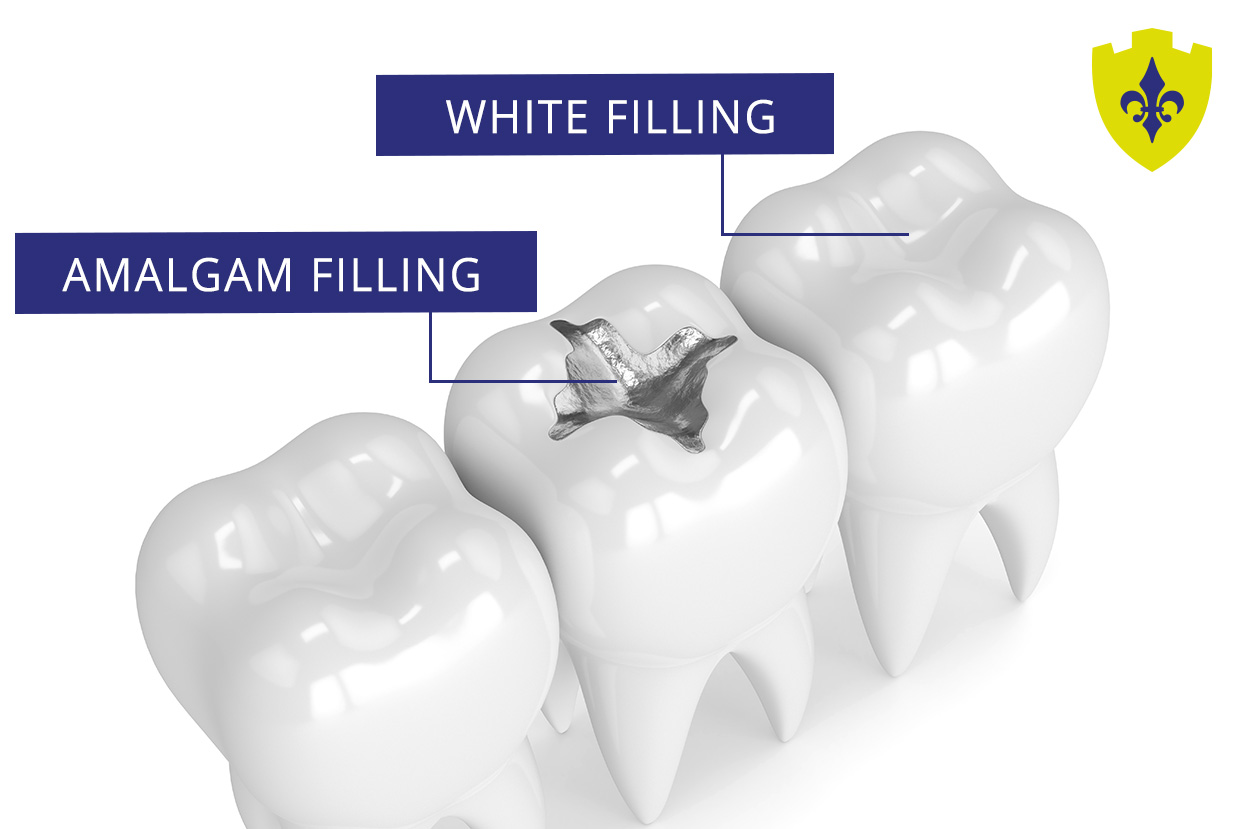 white fillings in  Bangor and Newtownards